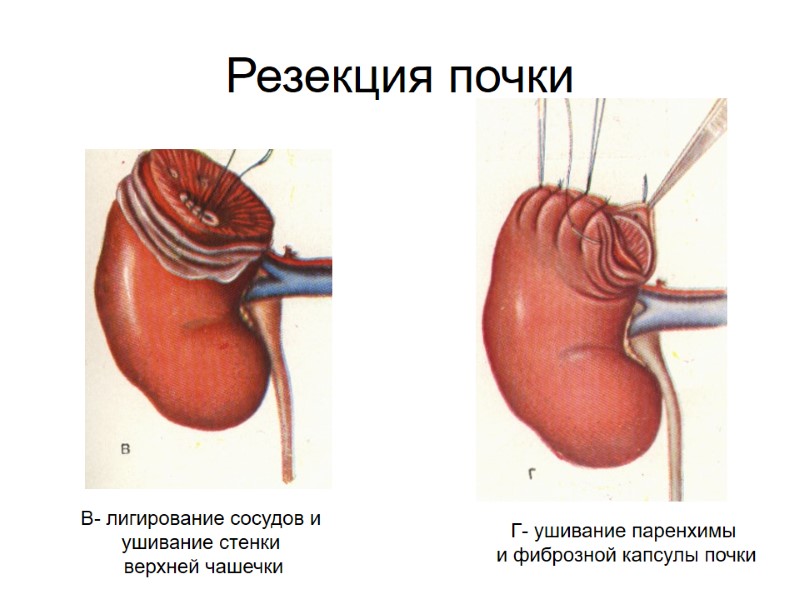 Резекция почки Г- ушивание паренхимы  и фиброзной капсулы почки В- лигирование сосудов и